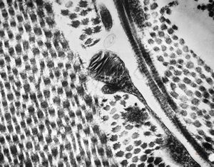 M, 48y. | Fabry disease - cornea